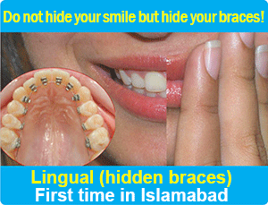 lingual braces